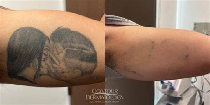 How do you get a shoulder tattoo off
