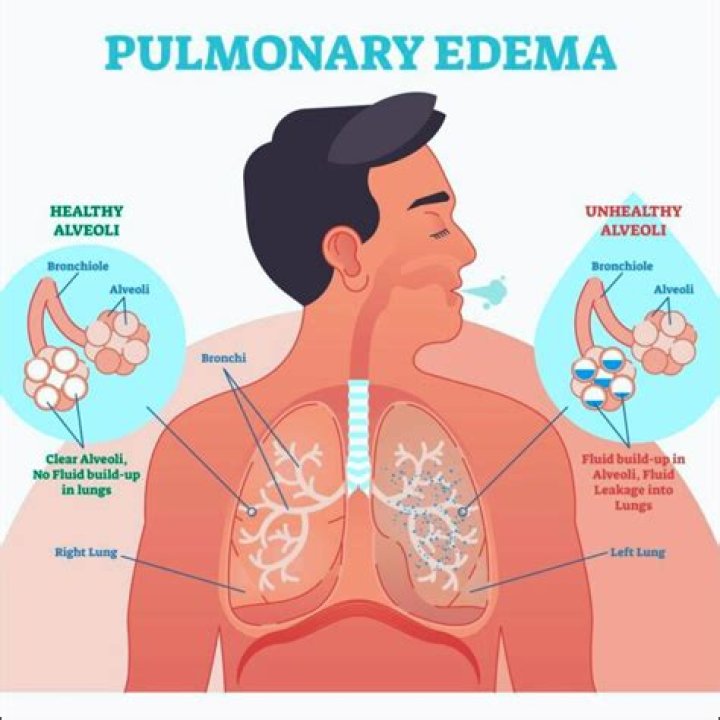 How do you get flash pulmonary edema