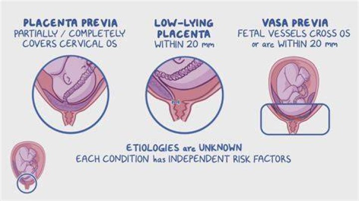 Is velamentous cord insertion considered high risk