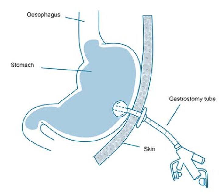 Why would you have a gastrostomy